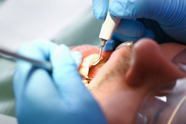 Best Emergency Root Canal Therapy in Key West, FL